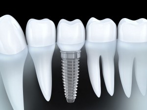 Dental implants weston ct | fairfield dental arts