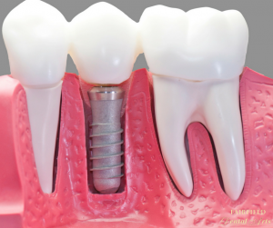 dental implants weston ct | fairfield county dentist