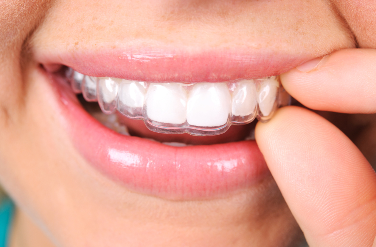 Close up of a person putting in a retainer.