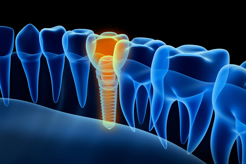 Fake tooth inserted next to real teeth