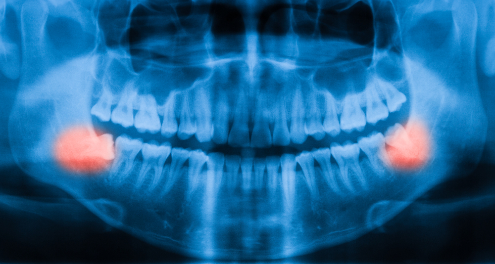 x-ray of wisdom teeth growing into gums