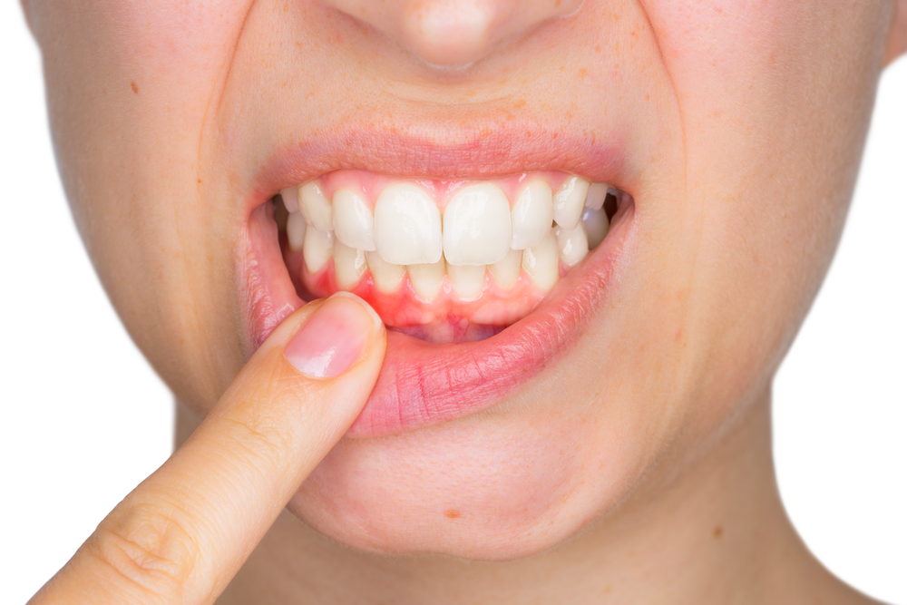 Woman puts finger on bleeding gums