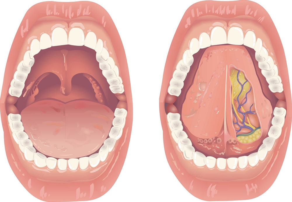 side by side of persons tongue showing Lingual arteries