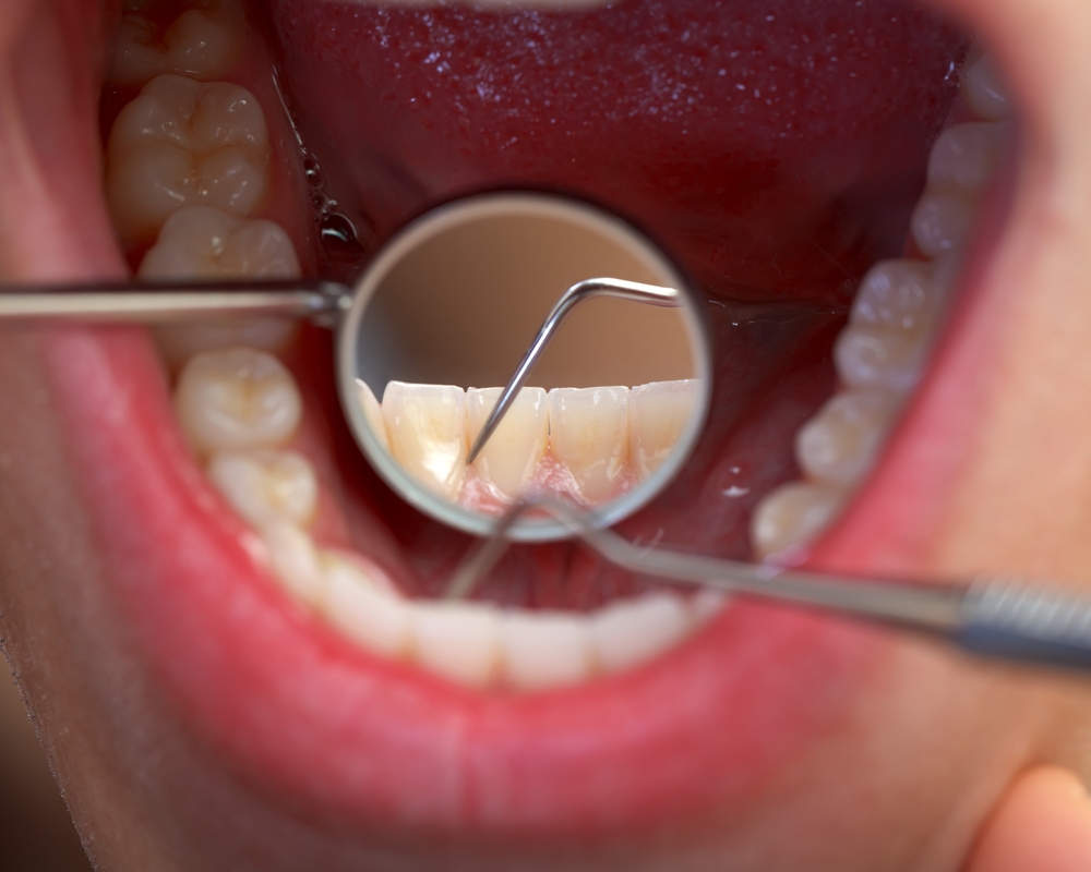 Dentist inspecting patients teeth with mirror