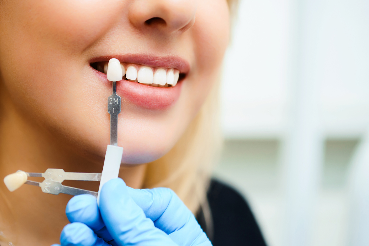 Young woman with smile matching the shades of a tooth implant