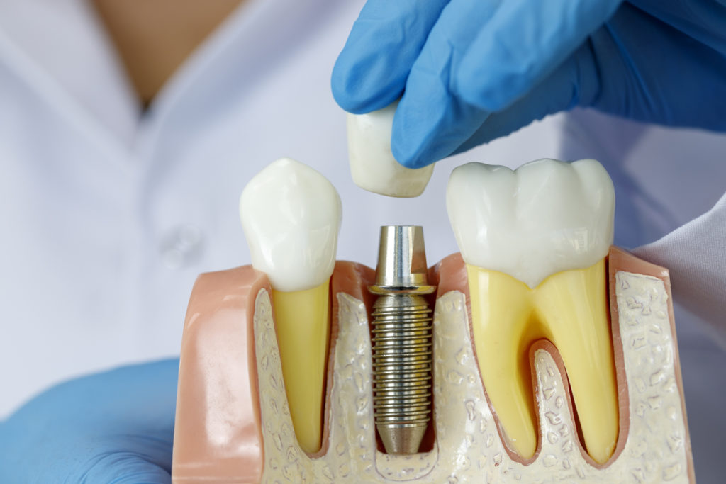 Doctor showing dental implant