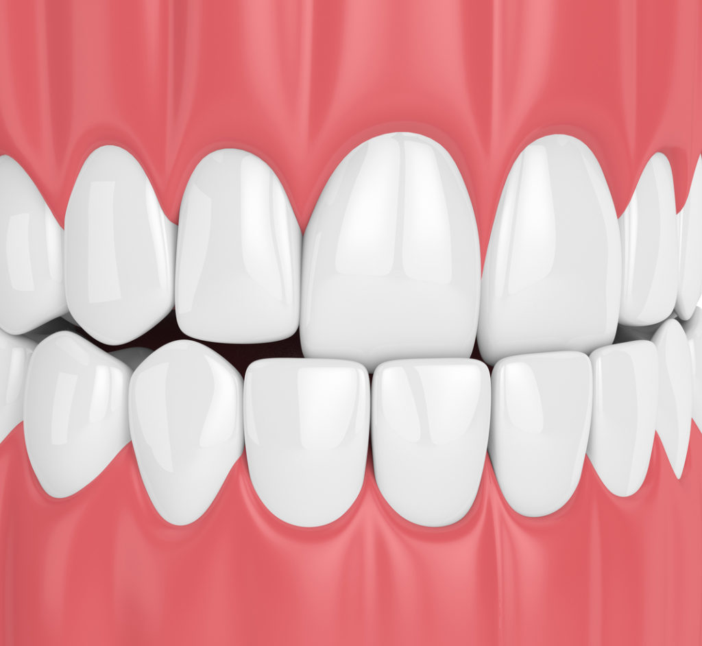3d render of jaw malocclusion with underbite