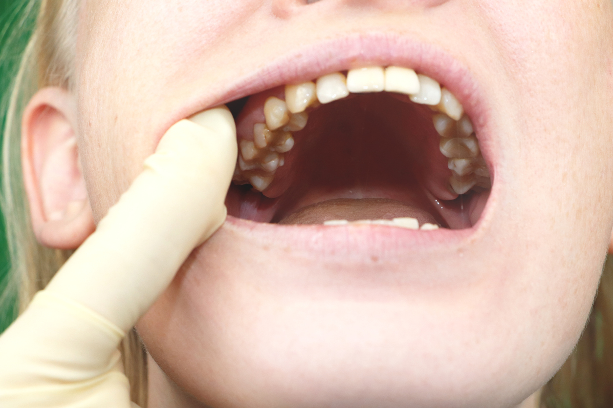 Woman holding mouth open to show dental plaque on her teeth