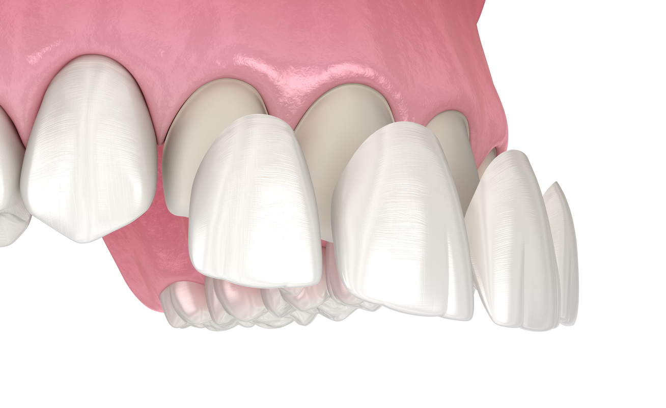 Close up animation of cosmetic bonding procedure