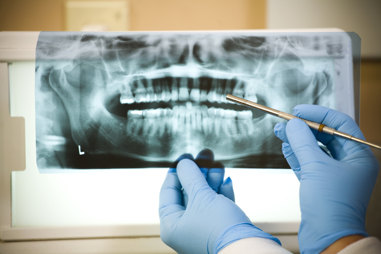 Dental X-Ray