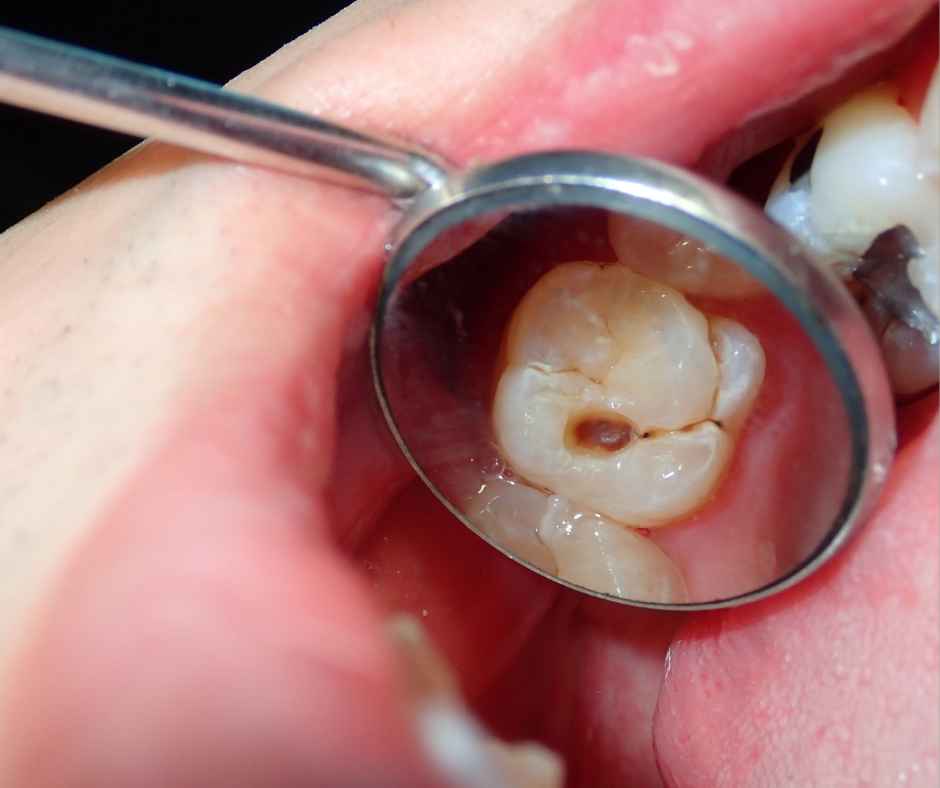 A dental cavity